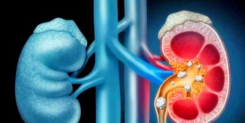 肾结石吃角瓜,角瓜助力健康排石新选择 第2张 肾结石吃角瓜,角瓜助力健康排石新选择 第2张